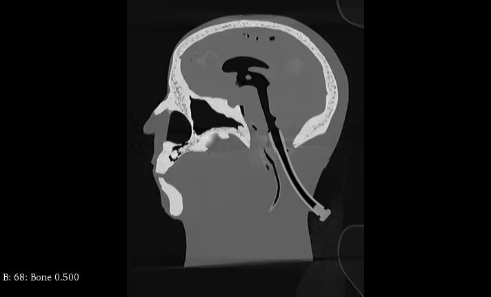 Adult Head Phantom (Standard) for X-Ray CT, US, MRI