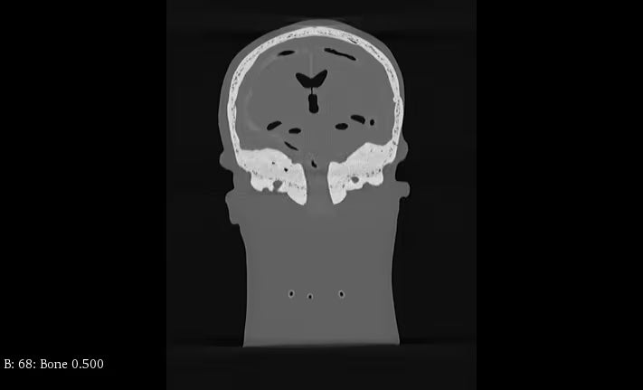 Adult Head Phantom (Standard) for X-Ray CT, US, MRI