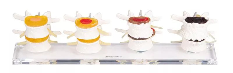 Stages of Disc Degeneration Model