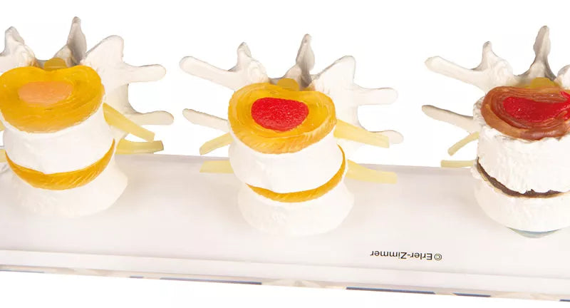 Parts of the disc degeneration model 7577 3