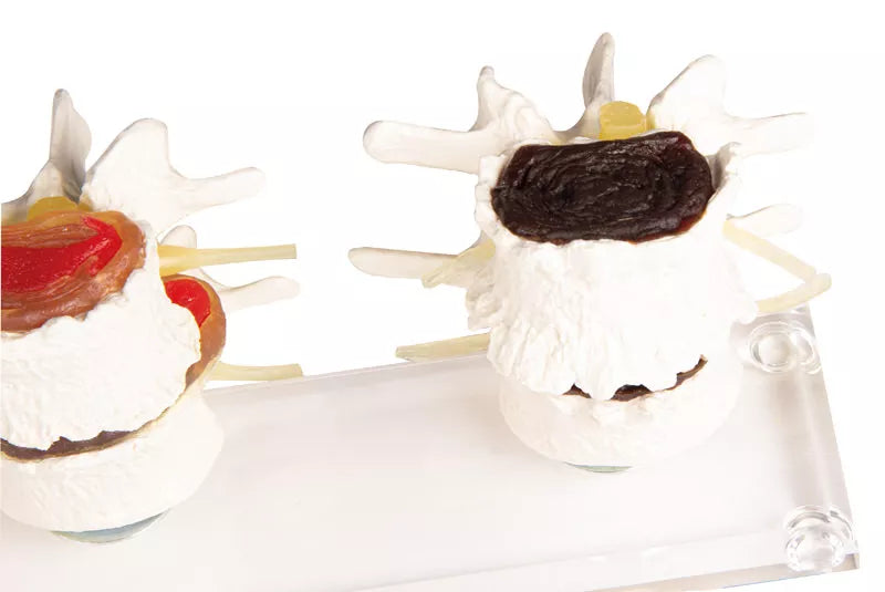 Parts of the disc degeneration model 7577 4