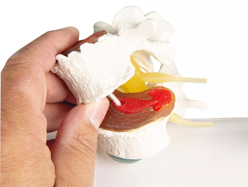 Parts of the disc degeneration model 7577