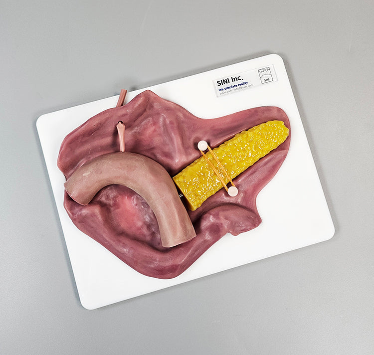 Pancreatojejunostomy Anastomosis Plate