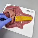 Switch Pancreatojejunostomy Anastomosis Plate A-PAP-01 Image 2 2 image