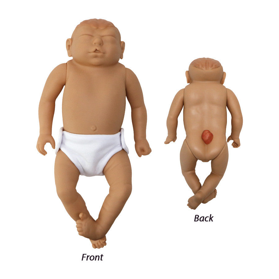 Birth Defects Baby
