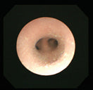 Switch Bronchi Image 2 image