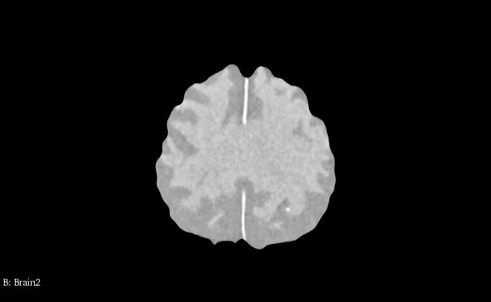 Adult Brain Phantom (Complex) for X-Ray CT, US, MRI
