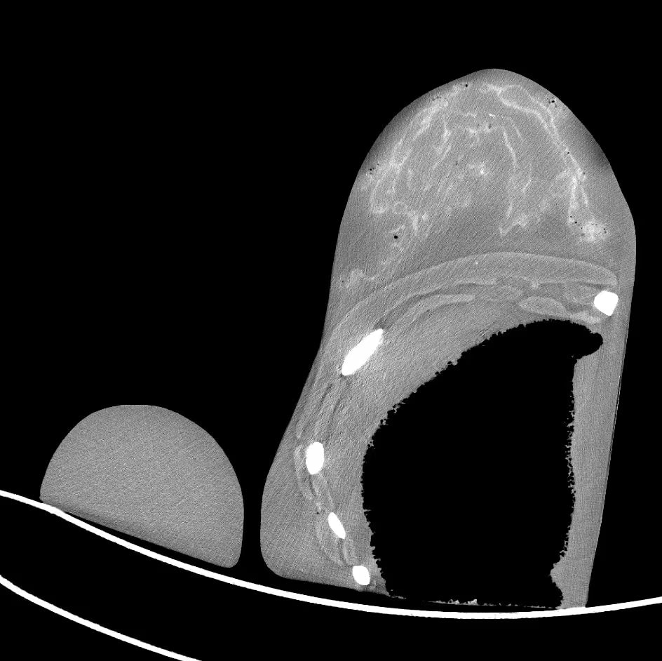 Adult Breast Phantom (Complex) for X-Ray CT, US, MRI