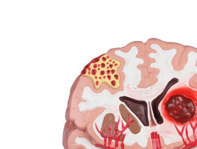 Brain Pathologies Anatomy Model