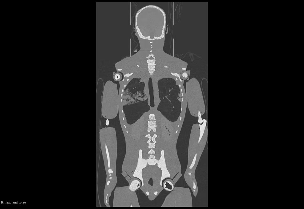 Adult Full Body Phantom with Muscles for X-Ray CT, MRI
