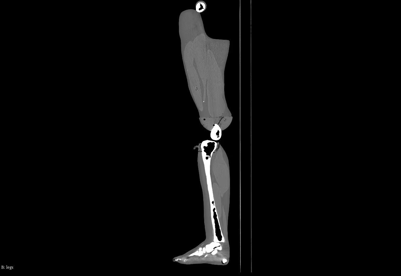 Adult Full Body Phantom with Muscles for X-Ray CT, MRI