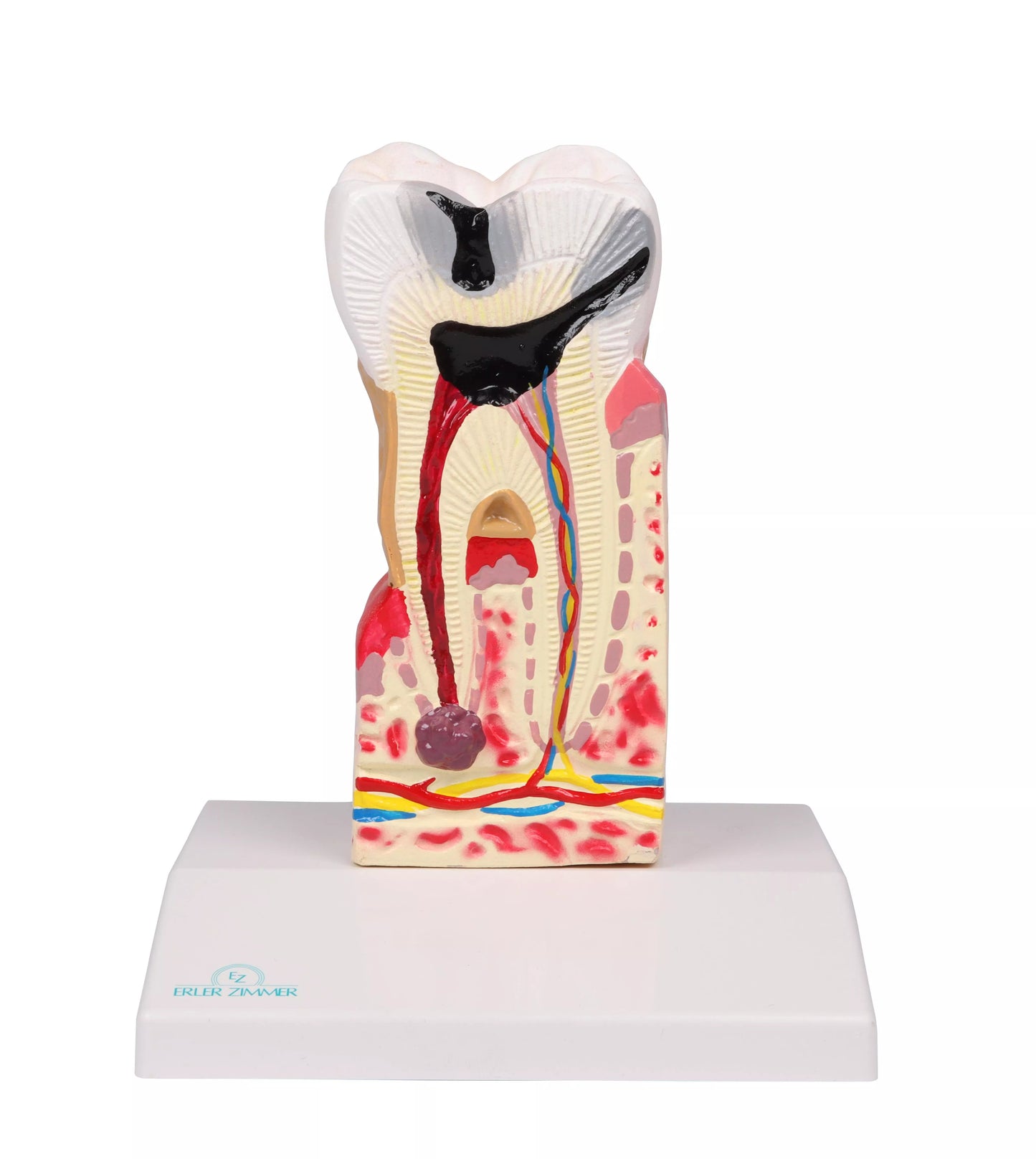 D214 Tooth Decay Model front