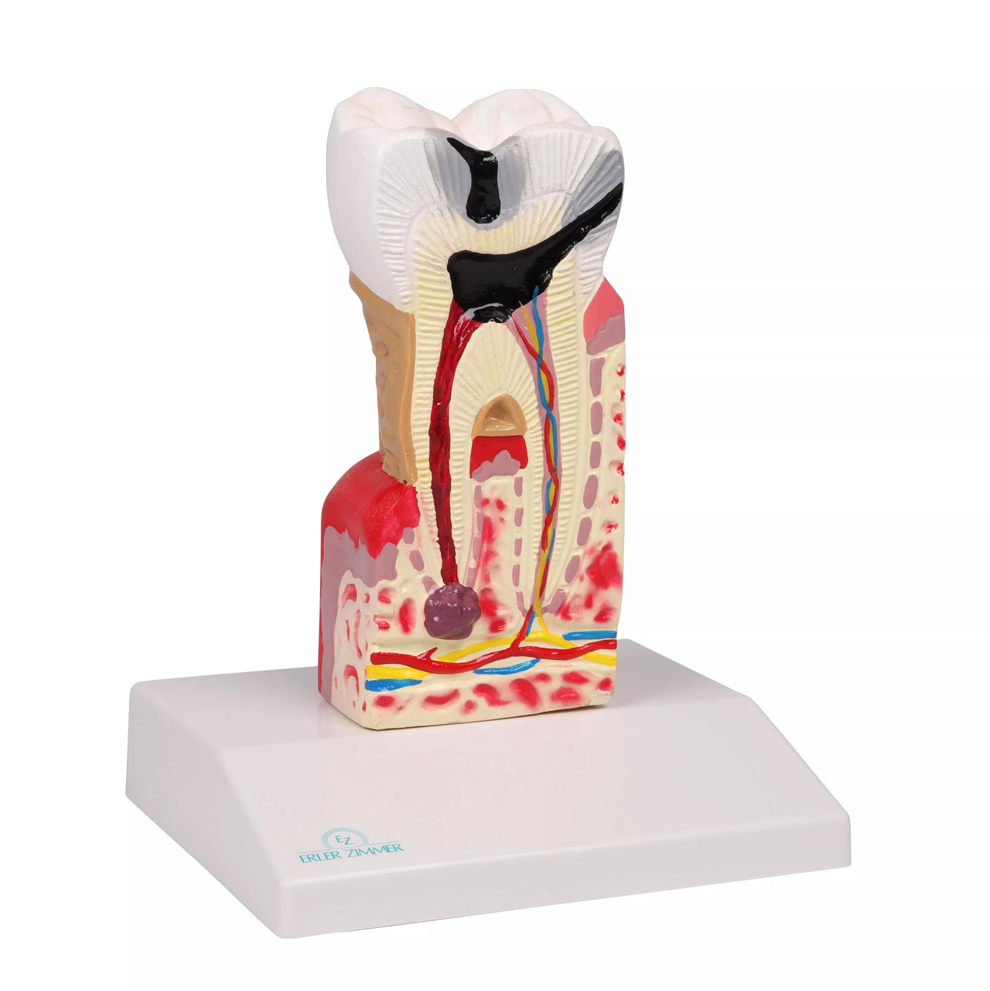 D214 Tooth Decay Model diagonal 