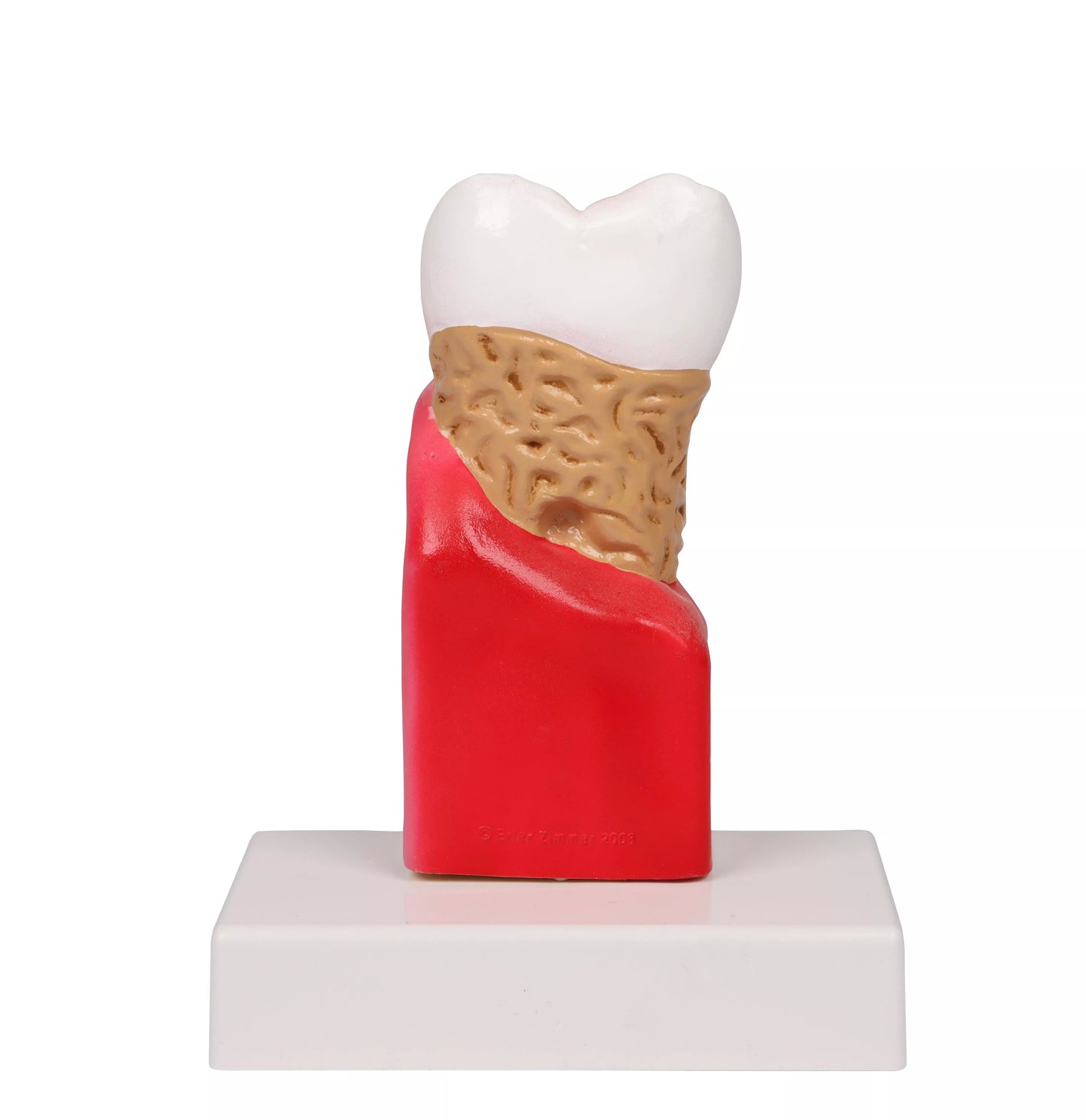D214 Tooth Decay Model side view