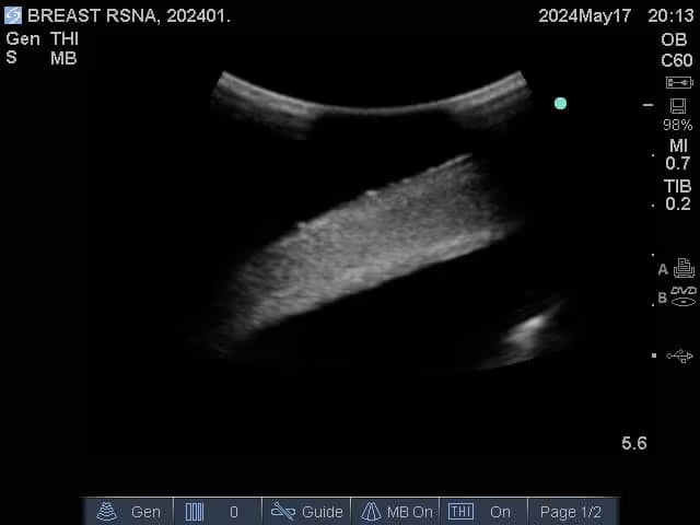 Adult Breast Phantom (Complex) for X-Ray CT, US, MRI