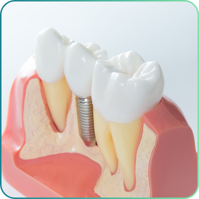 Dental Models