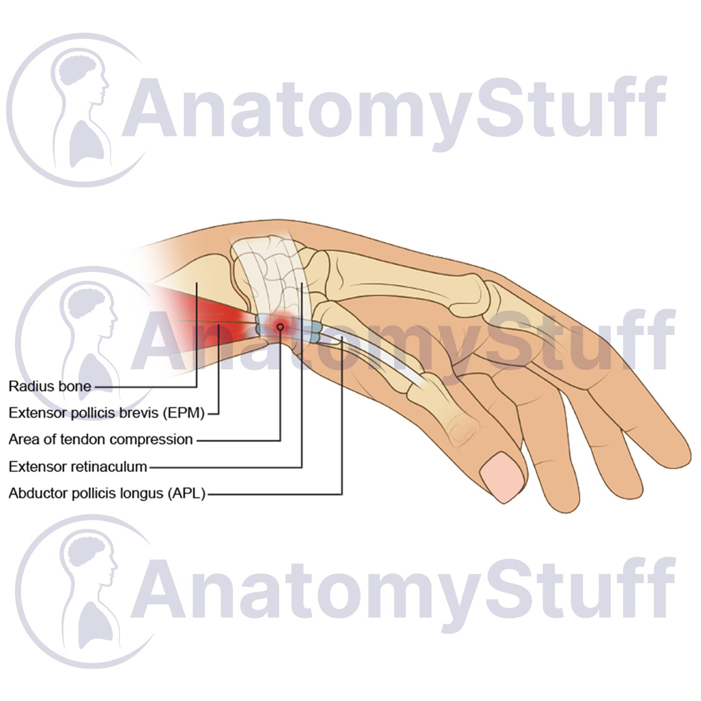 De Quervain’s Tenosynovitis Illustration
