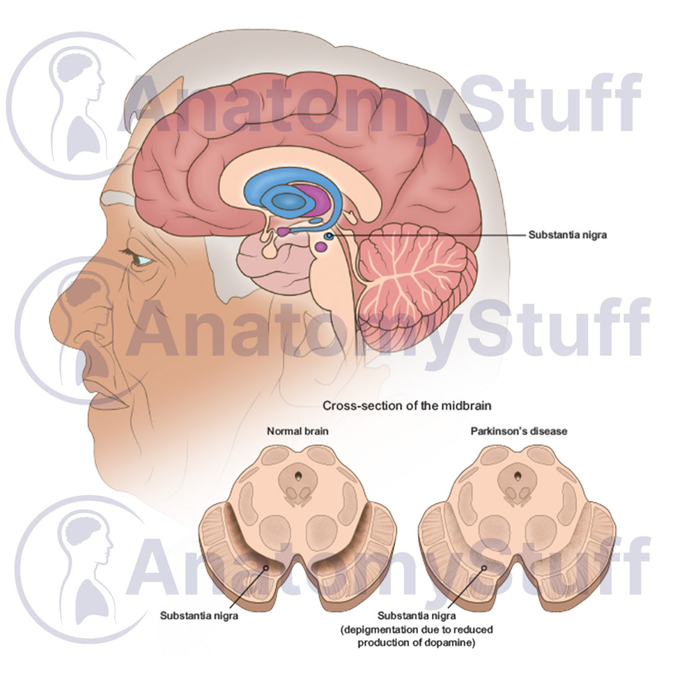 Parkinson's Disease Illustration