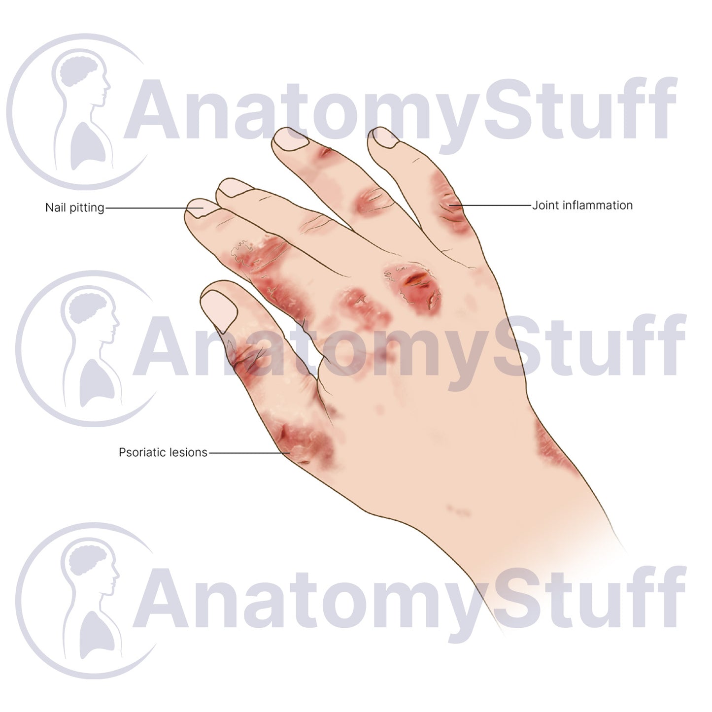 Psoriatic Arthritis Illustration