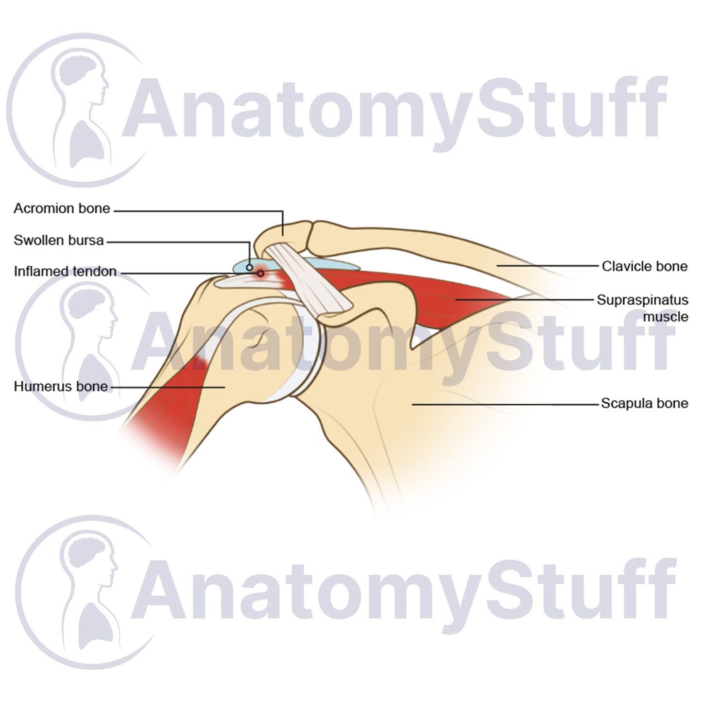 Shoulder Impingement Illustration
