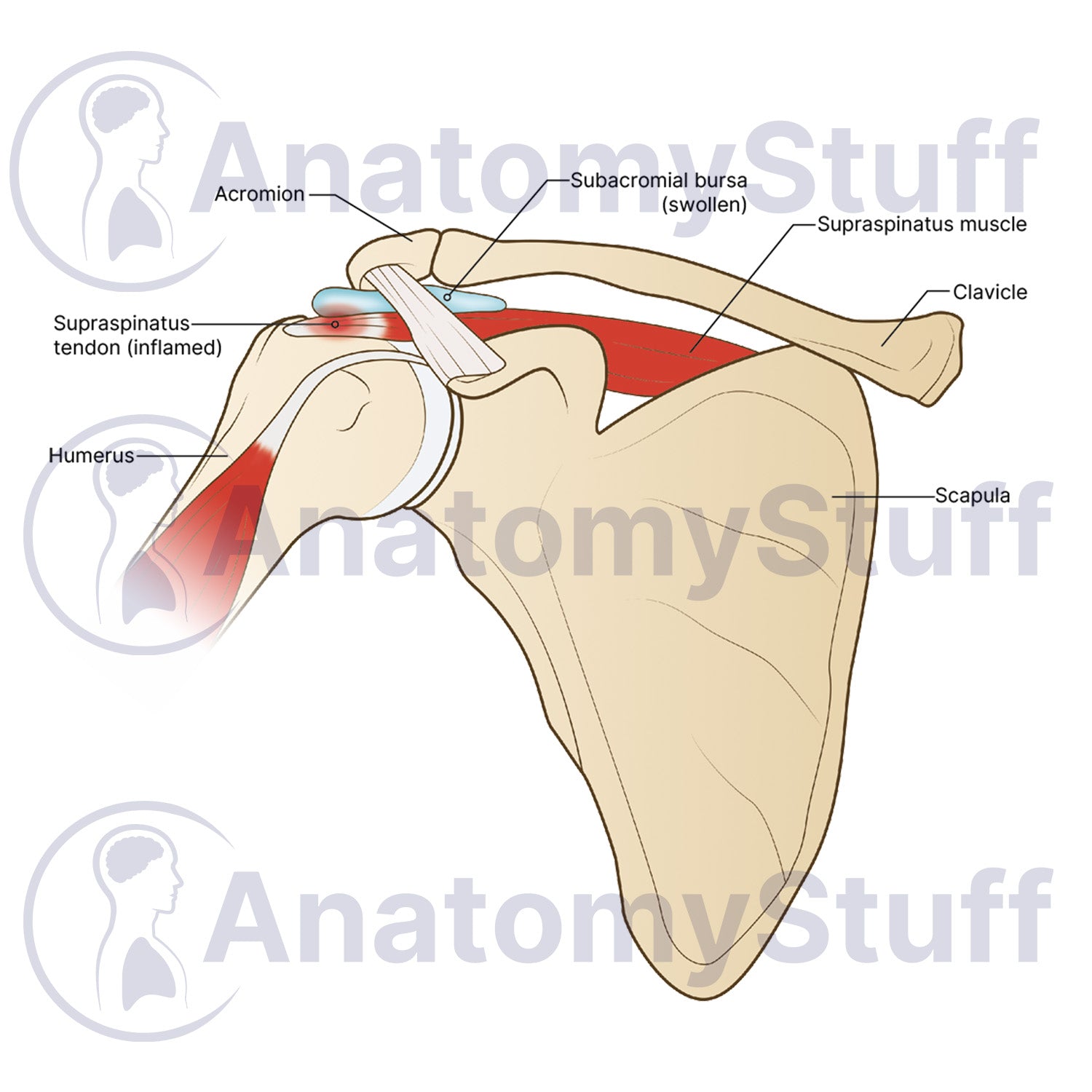 Shoulder Impingement Illustration