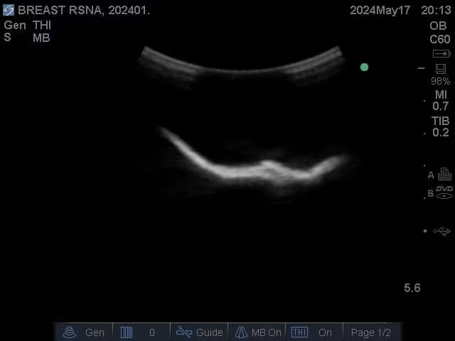 Adult Breast Phantom (Complex) for X-Ray CT, US, MRI