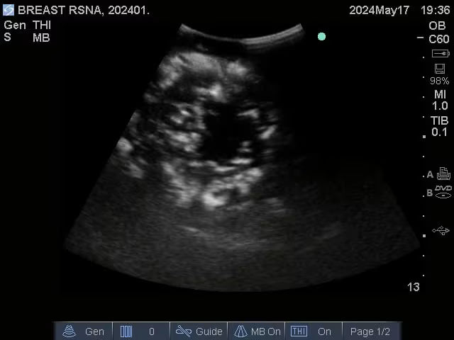 Adult Breast (Complex) for X-Ray CT, US, MRI BT-A01 Image 10
