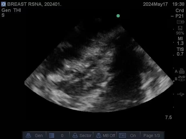 Adult Breast Phantom (Complex) for X-Ray CT, US, MRI