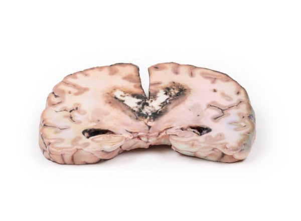 Glioma 3D Printed Anatomy Model