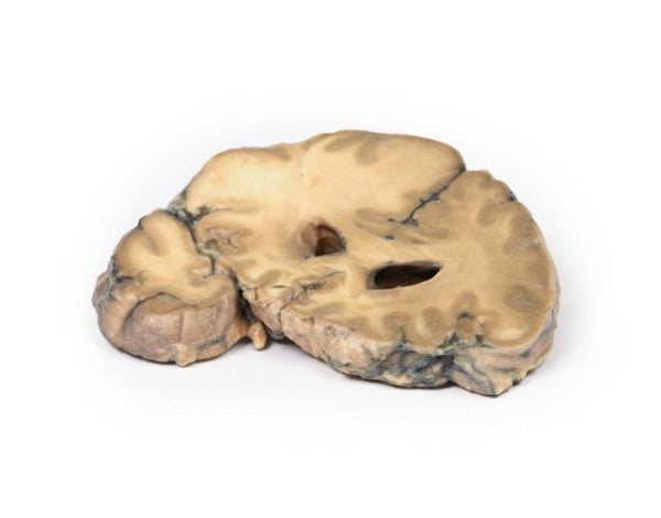 Opposite side of the metastatic adenocarcinoma in the brain model