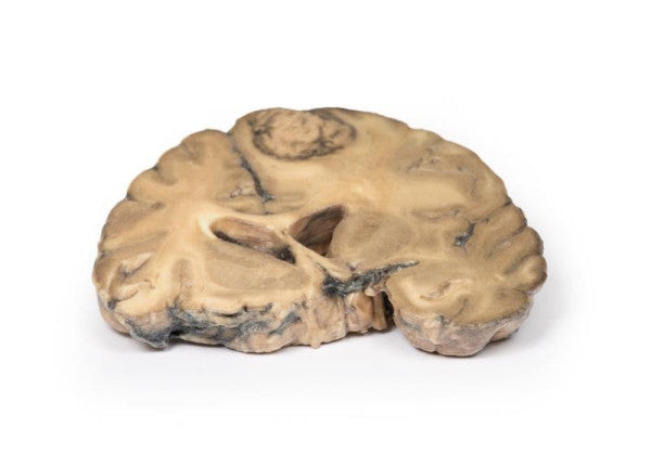 Carcinoma 3D Printed Anatomy Model
