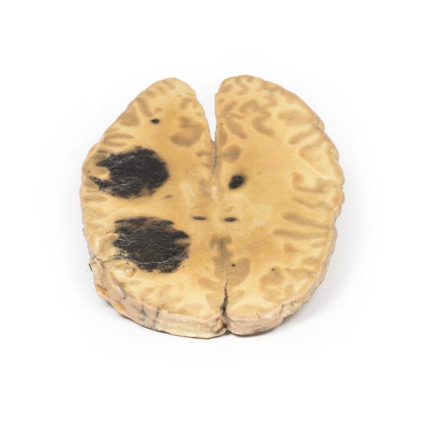 Cerebral Haemorrhage 3D Printed Anatomy Model