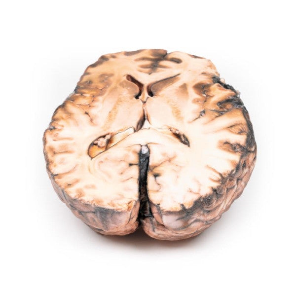 Aneurysm 3D Printed Anatomy Model