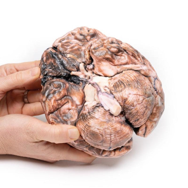 Aneurysm 3D Printed Anatomy Model