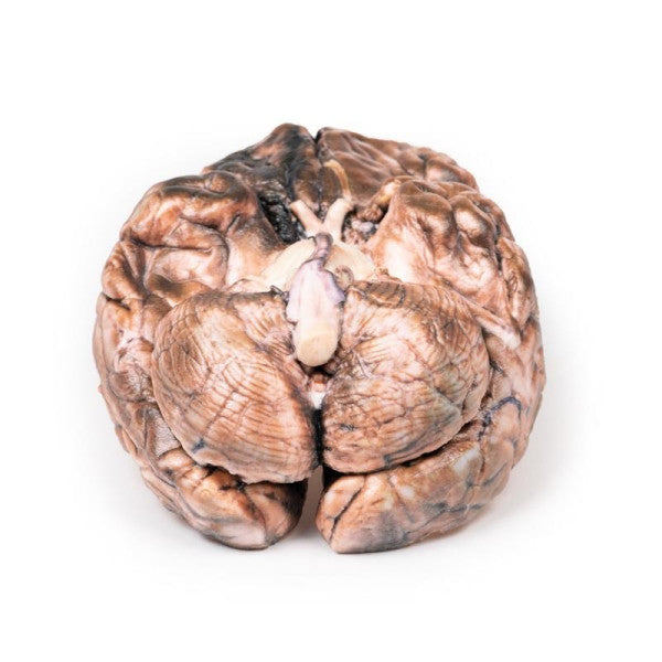 Ruptured Berry Aneurysm Model
