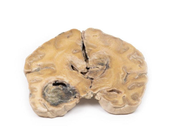 Glioma 3D Printed Anatomy Model