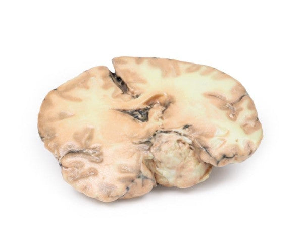 Opposite side of the glioblastoma multiforme model