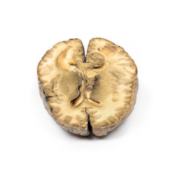 Opposite side of the metastatic carcinoma in the brain model