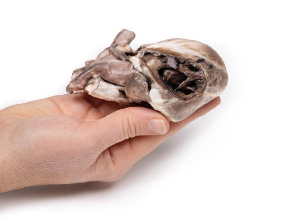 Heart Pathology 3D Printed Anatomy Model