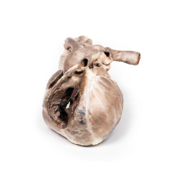 Heart Pathology 3D Printed Anatomy Model