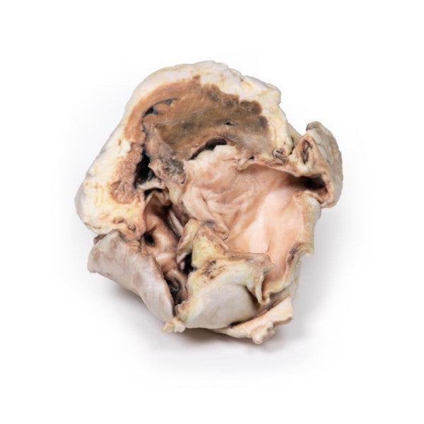 Valvular Disease 3D Printed Anatomy Model