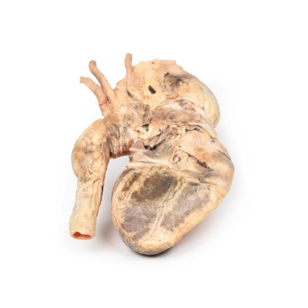 Aneurysm 3D Printed Anatomy Model