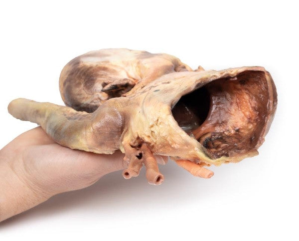 Aneurysm 3D Printed Anatomy Model