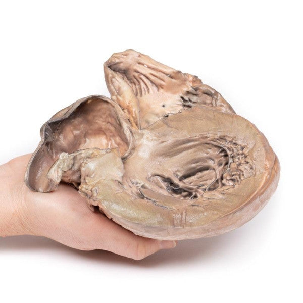 Aneurysm 3D Printed Anatomy Model