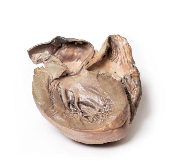 Aneurysm 3D Printed Anatomy Model