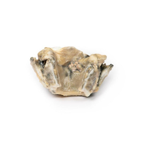 Carcinoma of the Larynx Model (Posterior Aspect)