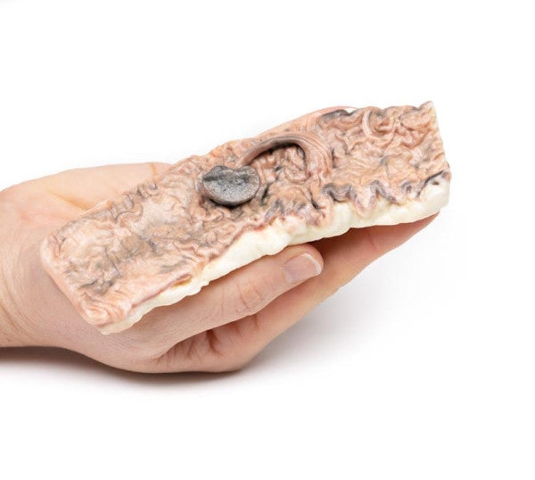 Frontal View of the Pedunculated Adenoma of the Colon Model