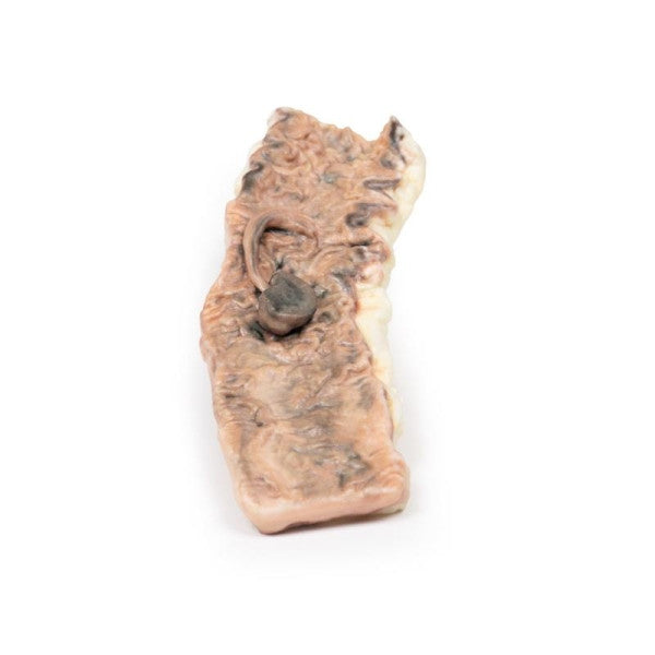 Adenoma 3D Printed Anatomy Model