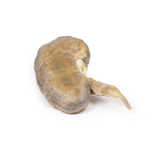 Posterior Aspect of the Multiple Renal Calculi Model