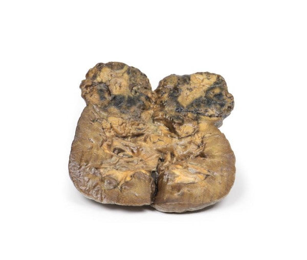 Carcinoma 3D Printed Anatomy Model